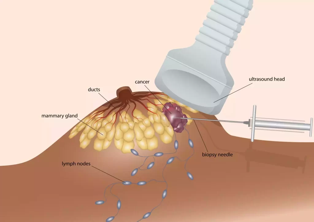 Biopsy