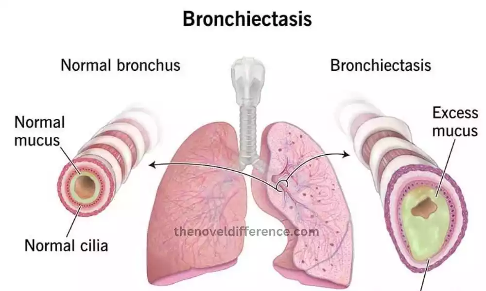 Bronchiectasis