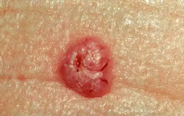 Carcinoma