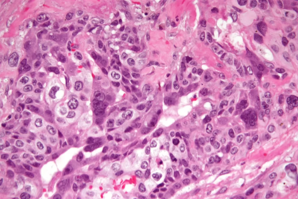 Choriocarcinoma