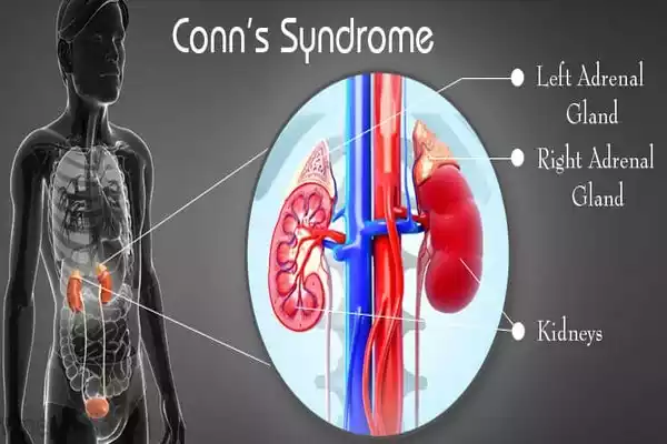 Conn's Syndrome