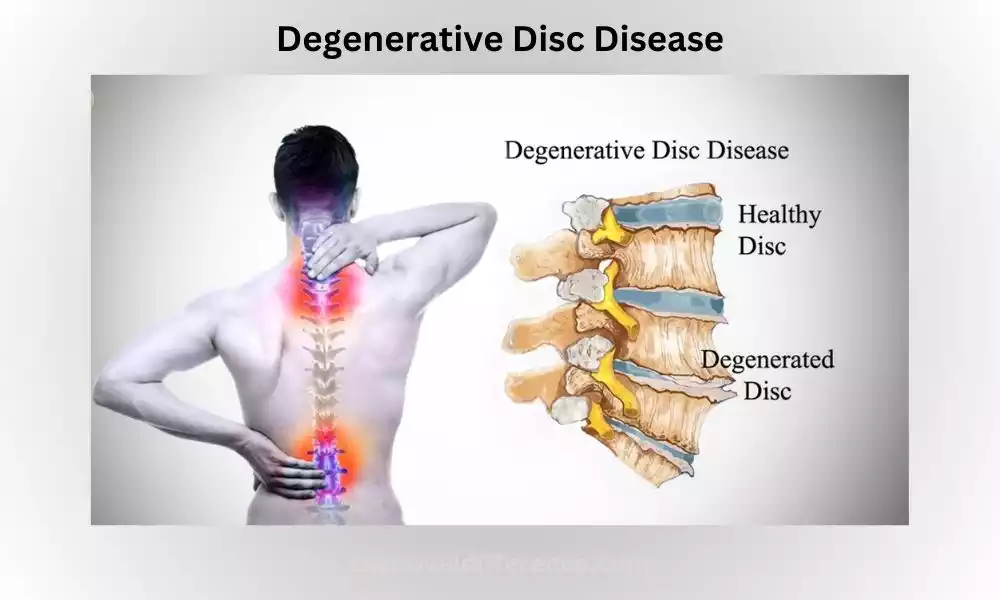 Degenerative Disc Disease