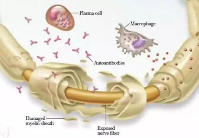 Demyelinating Neuropathy