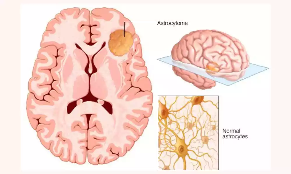 Difference Between Astrocytoma and Glioblastoma