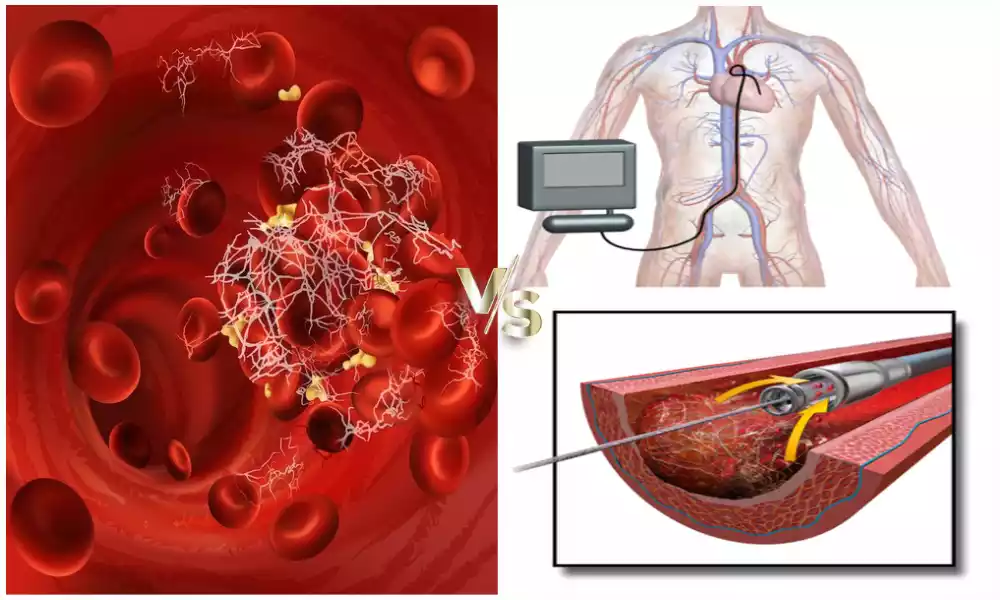 Difference Between Thrombolysis and Fibrinolysis