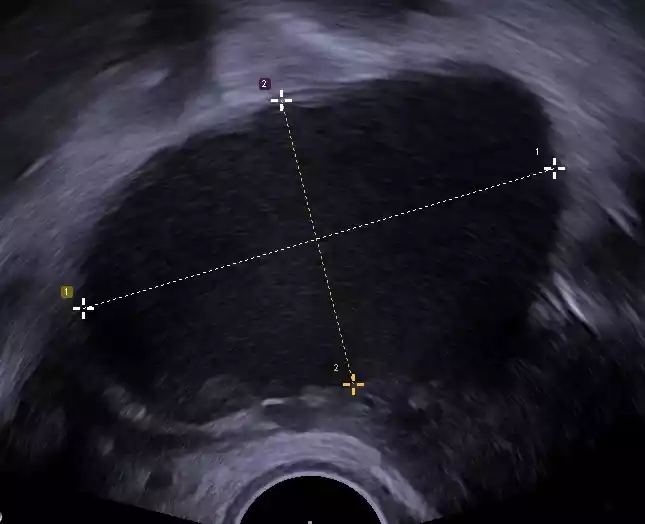 Endometrioma 