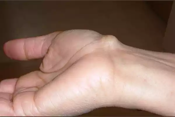 Ganglion Cyst