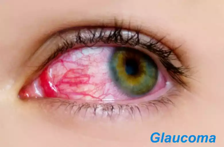 Glaucoma