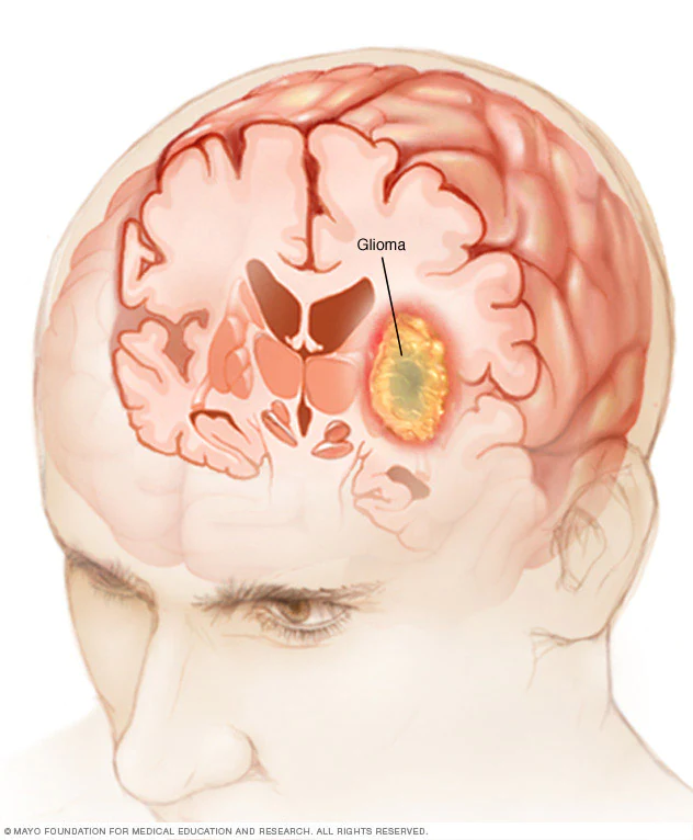 Glioblastoma