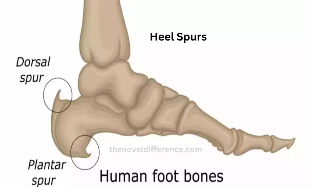 Heel Spurs