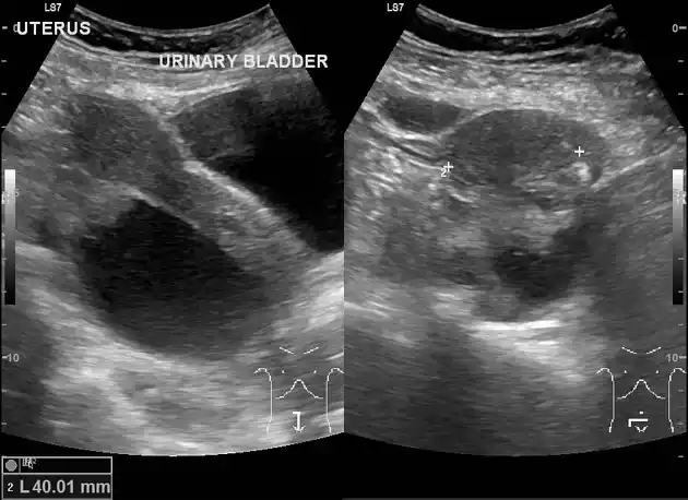 Hemorrhagic Cyst