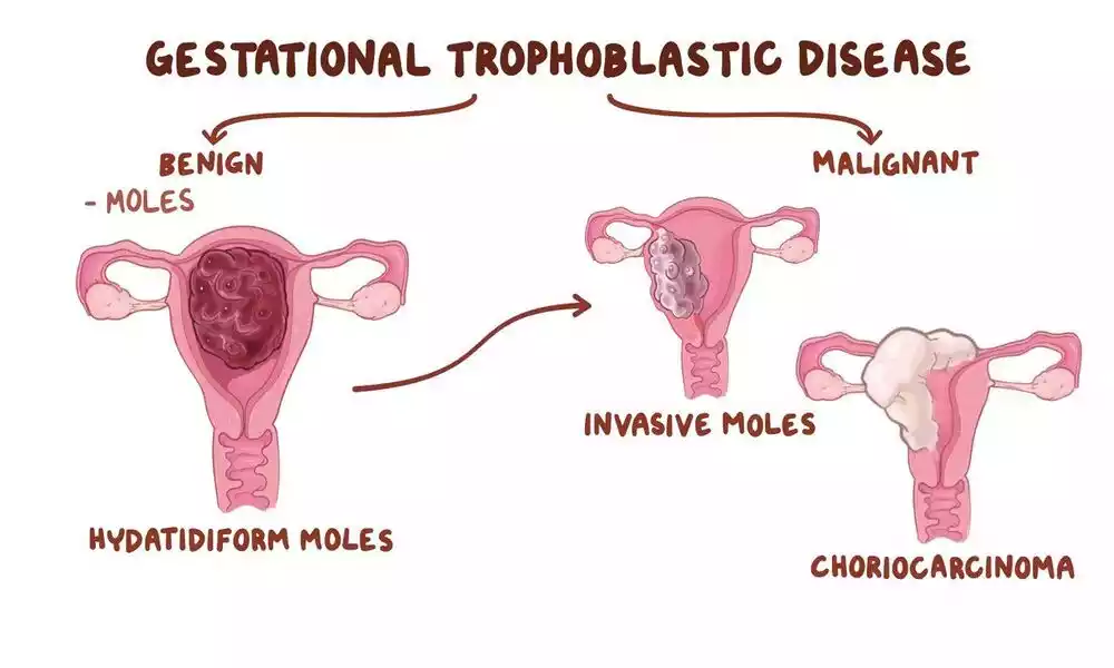 Between Hydatidiform Mole and Choriocarcinoma best 12 difference