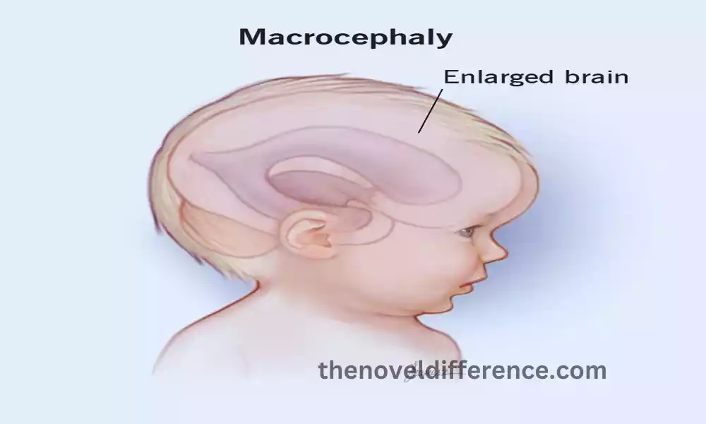 Hydrocephalus