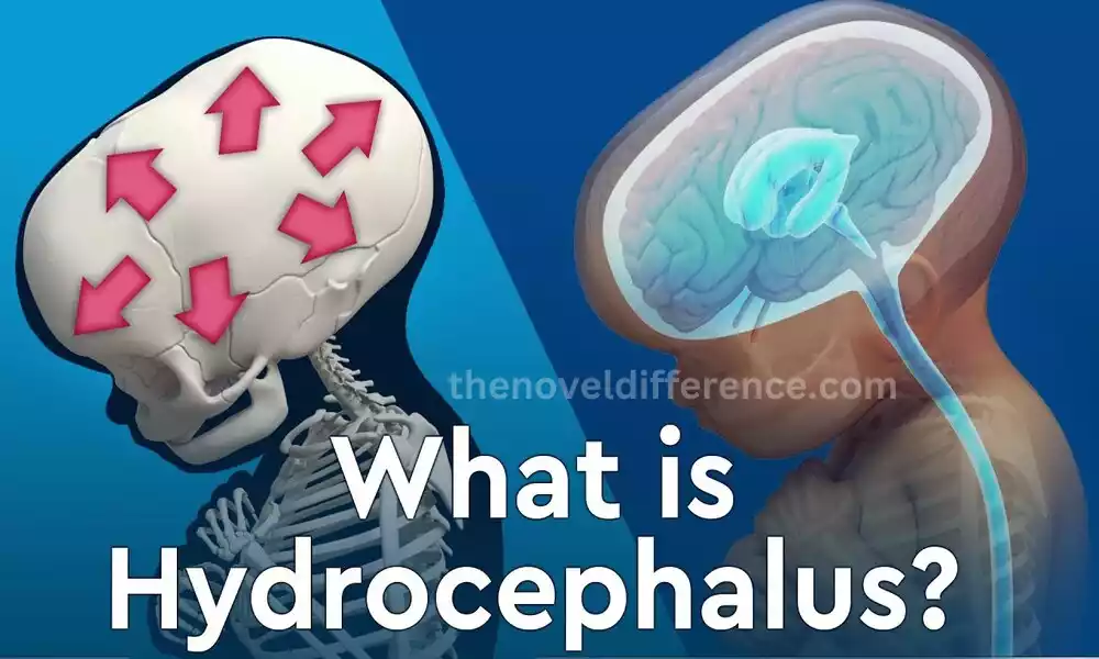 Hydrocephalus