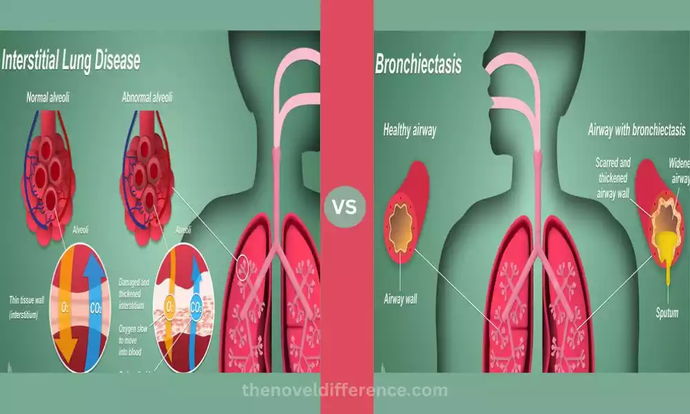 Difference Between Interstitial Lung Disease and Bronchiectasis