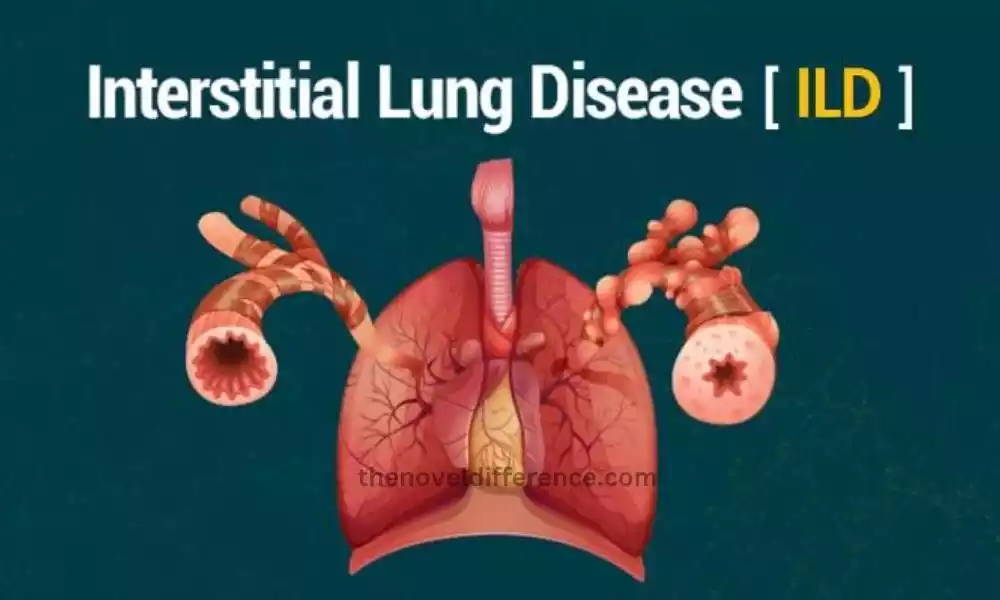 Interstitial Lung Disease