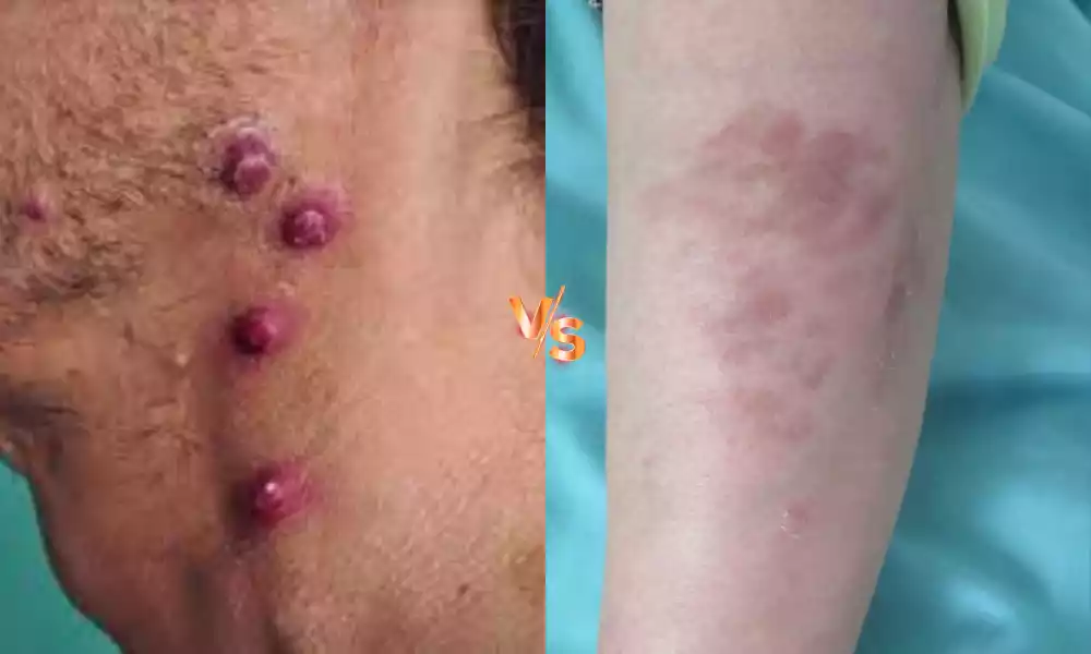 Between Kaposi Sarcoma and Bacillary Angiomatosis the top 10 difference