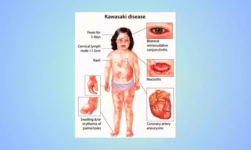 Kawasaki Disease