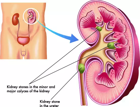 Kidney Stones