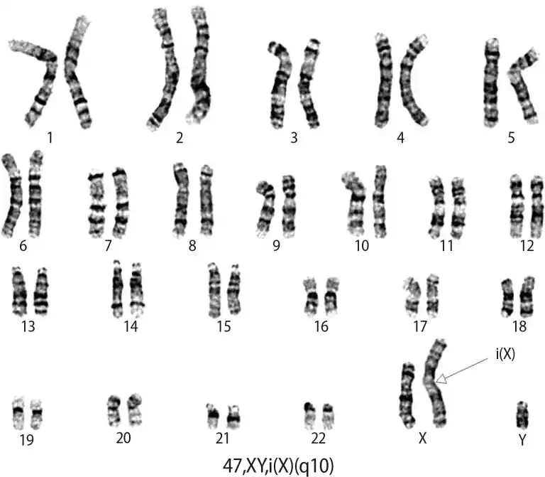 Klinefelter syndrome