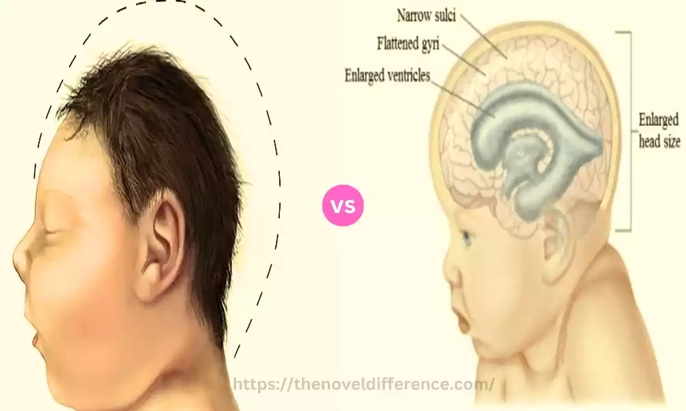 Difference Between Macrocephaly and Hydrocephalus