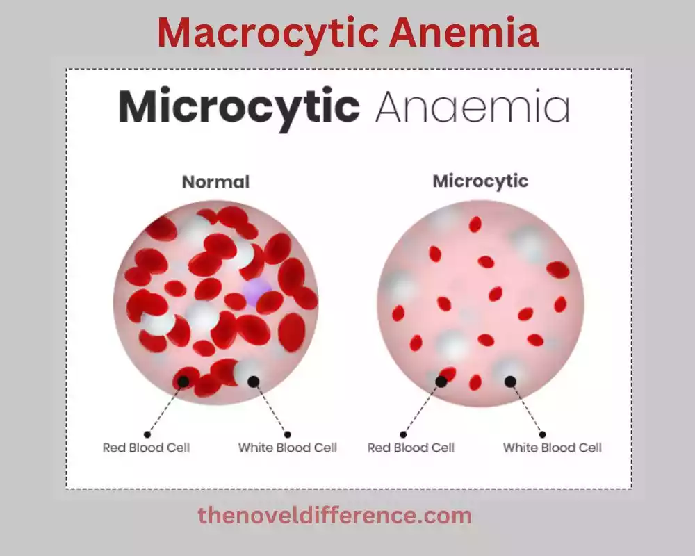 Macrocytic Anemia