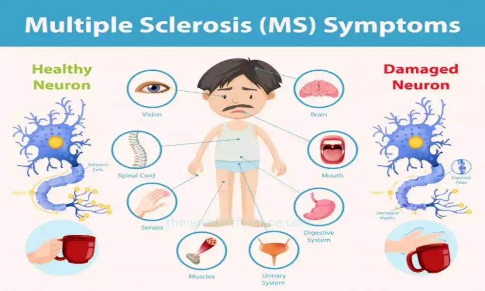 Multiple Sclerosis (MS)