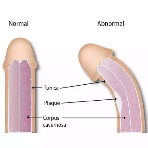 Normal Penile Curvature