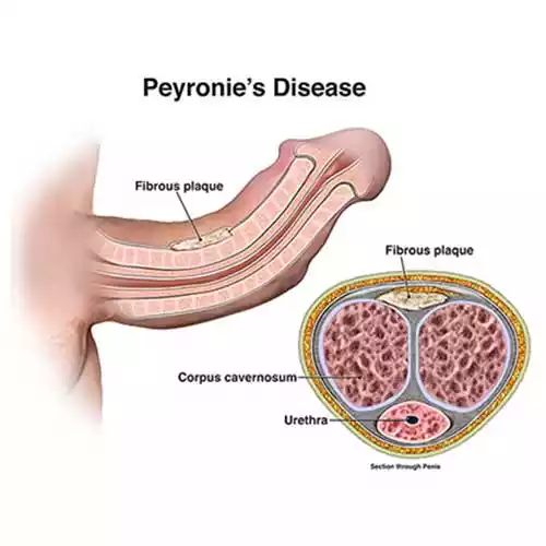 Peyronie Disease