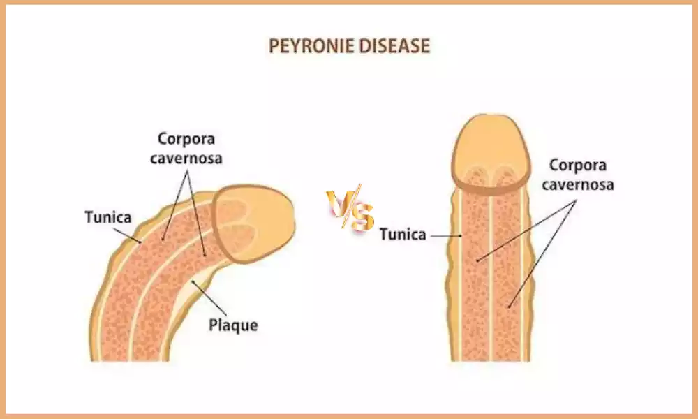 Between Peyronie’s and Curve best 10 difference