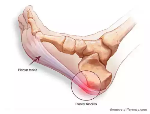 Plantar Fasciitis