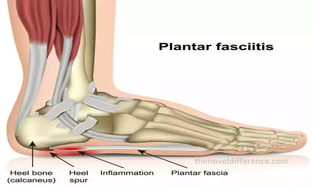 Plantar Fasciitis