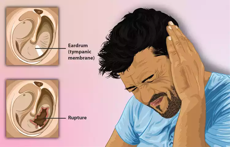 Ruptured Eardrum