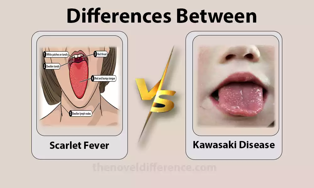 Difference Between Scarlet Fever and Kawasaki Disease