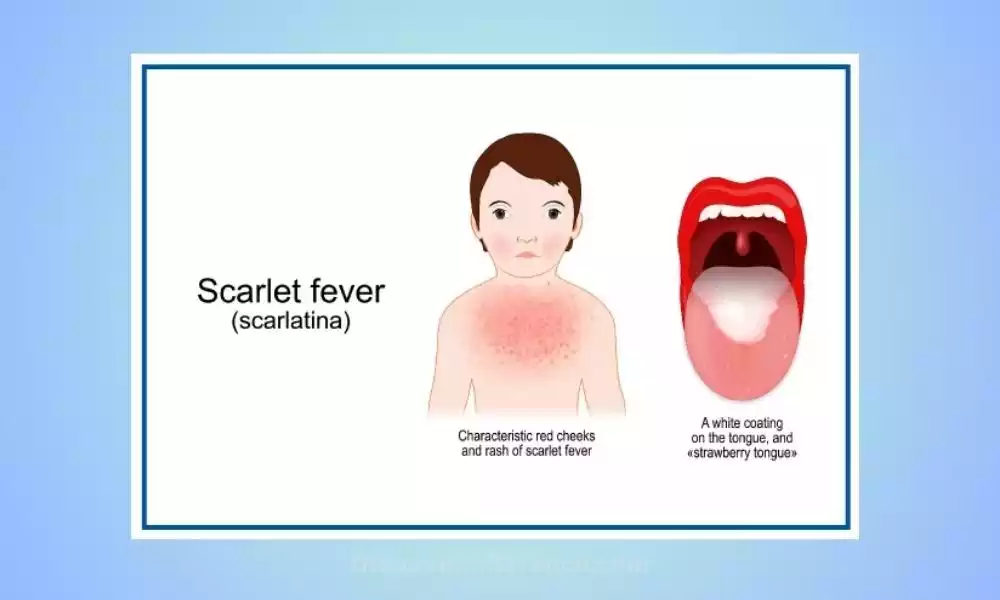 Scarlet Fever