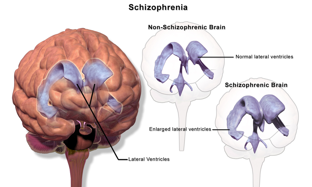 Schizophrenia