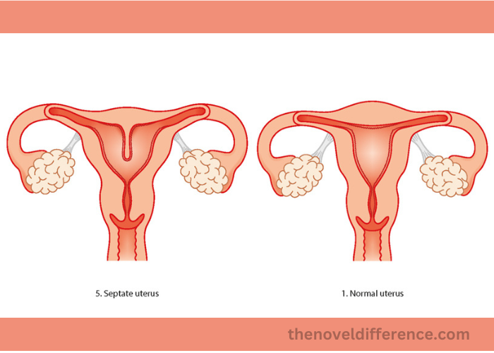 Septate Uterus