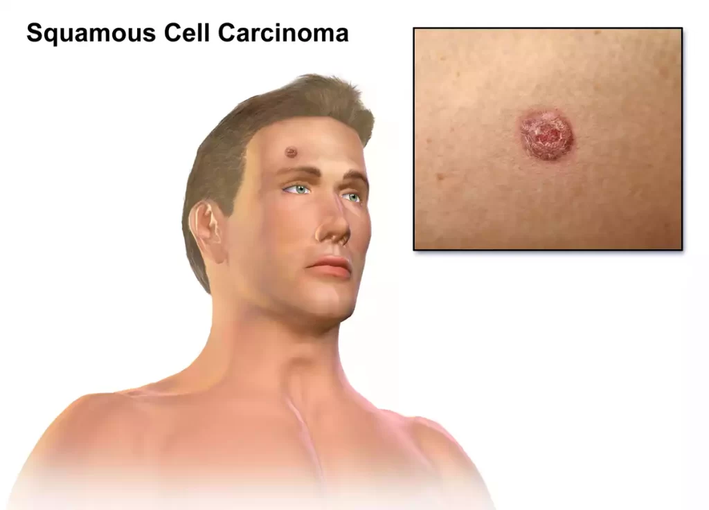 Squamous Cell Carcinoma