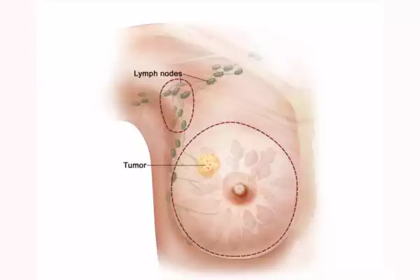 Stage 2 Breast Cancer