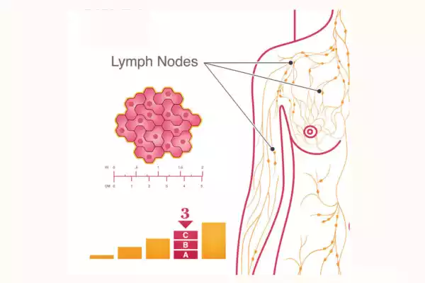 Stage 3 Breast Cancer