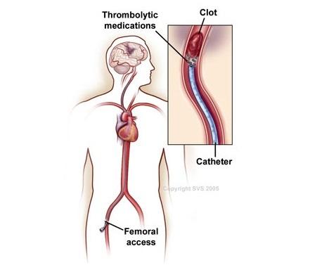 Thrombolysis