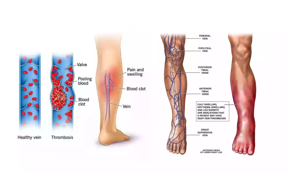 Between Thrombophlebitis and Phlebothrombosis the best 8 difference