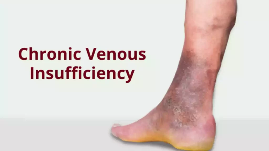 Venous Insufficiency