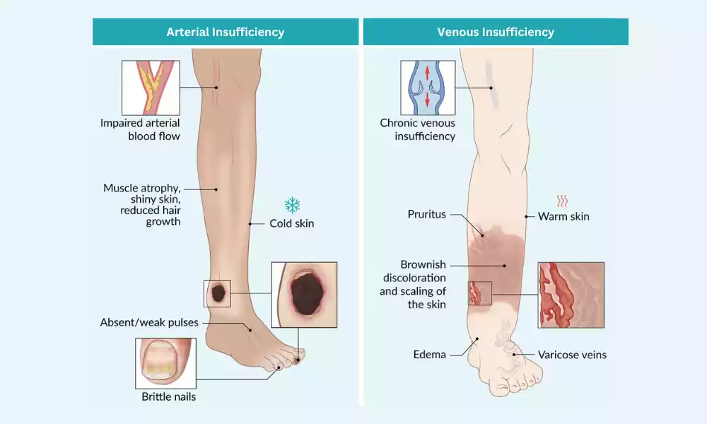 Between Venous and Arterial Insufficiency unique and best difference