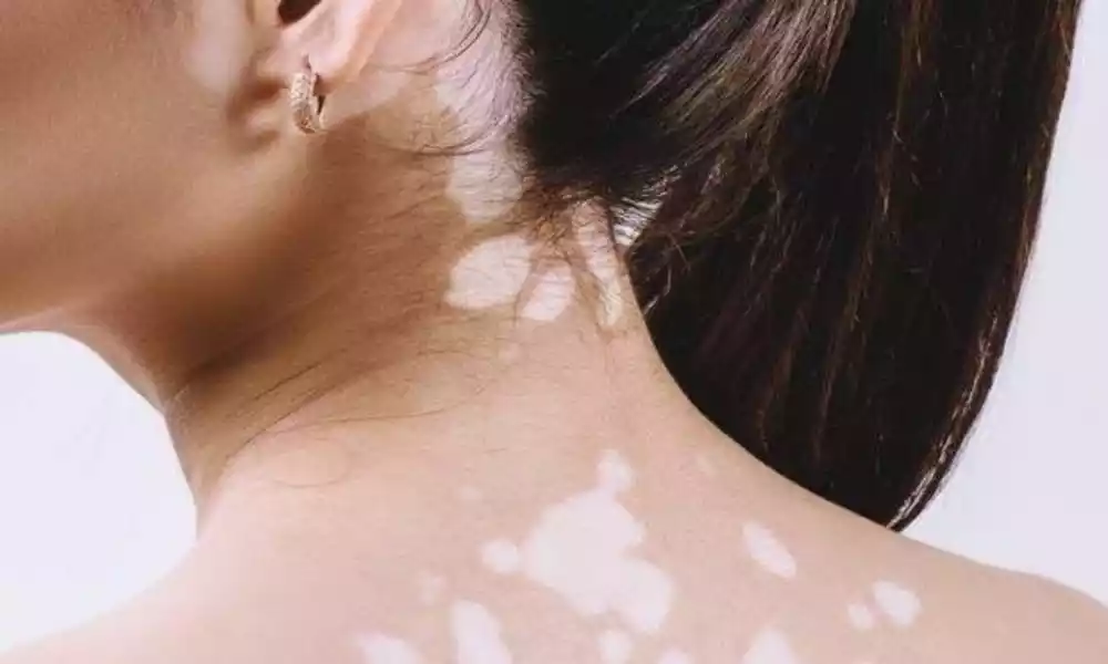 Difference Between Vitiligo and Psoriasis