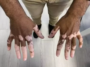 Vitiligo