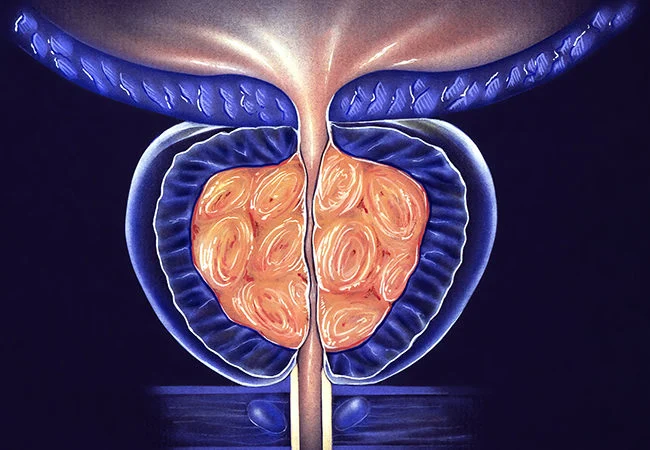 benign prostatic hyperplasia