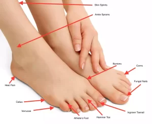 common foot conditions