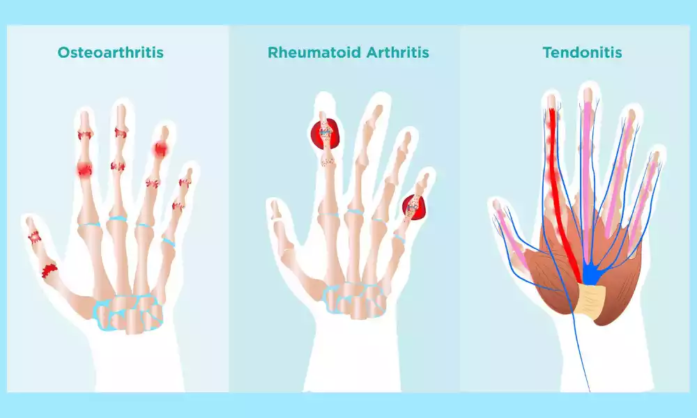 Between Tendonitis and Arthritis in Thumb top 13 difference