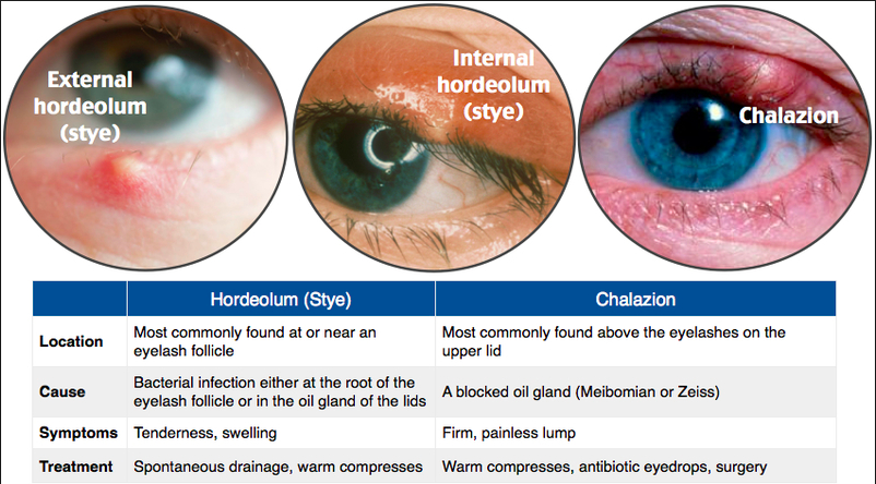 Difference Between Hordeolum and Chalazion